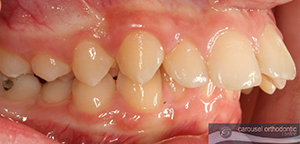 Overbite