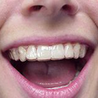 Retainers
