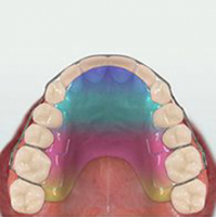Retainers