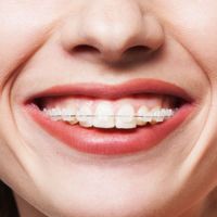 Ceramic braces