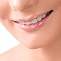 Clear braces