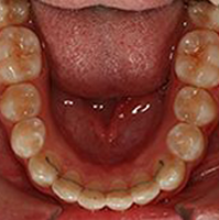Retainers