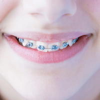 Metal braces