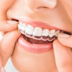 Invisalign
